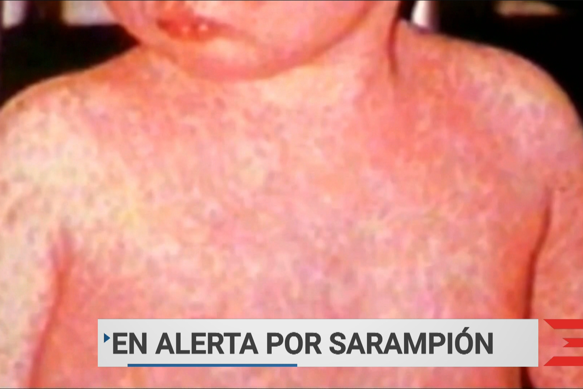 En Alerta Ante Brote De Sarampión Wapa Tv Noticias Videos